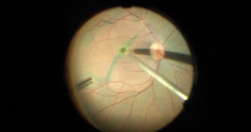 Persistent Full-Thickness Macular Hole