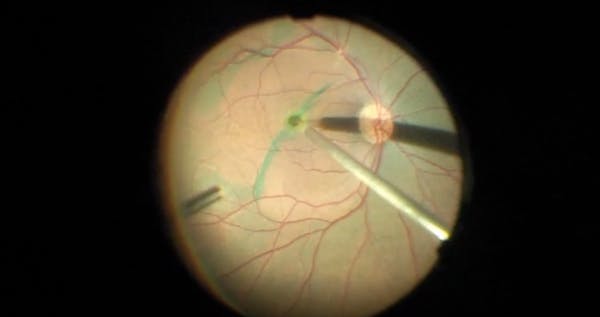 Persistent Full-Thickness Macular Hole thumbnail