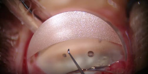 iTrack Canaloplasty and Tanito Micro Hook Goniotomy