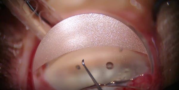 iTrack Canaloplasty and Tanito Micro Hook Goniotomy thumbnail