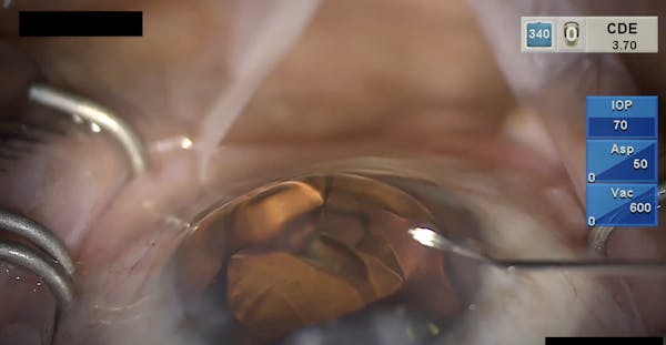 Surgical Saves: Hydrus Microstent thumbnail