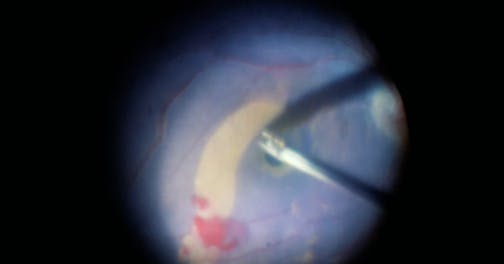 ILM Stalk Technique for Large Macular Holes