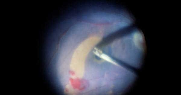 ILM Stalk Technique for Large Macular Holes thumbnail