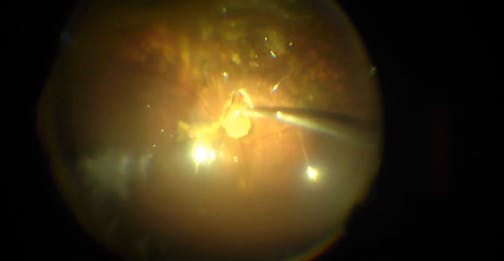 Complex Repair of Combined Tractional/Rhegmatogenous Retinal Detachment Following Plaque Radiotherapy for Choroidal Melanoma