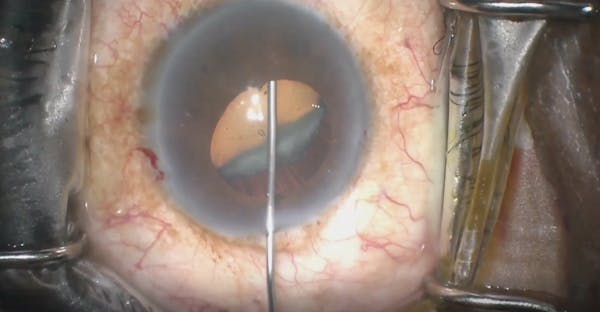 Removal of Cataract in Patient With Ectopia Lentis et Pupillae thumbnail