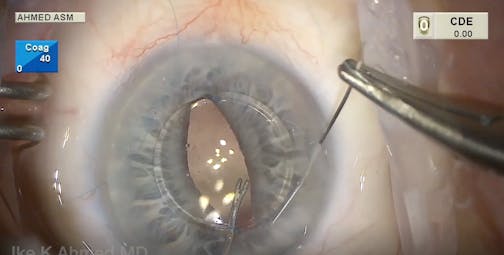 Iris-Sutured IOL Approach