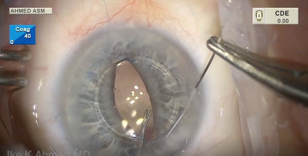 Iris-Sutured IOL Approach thumbnail