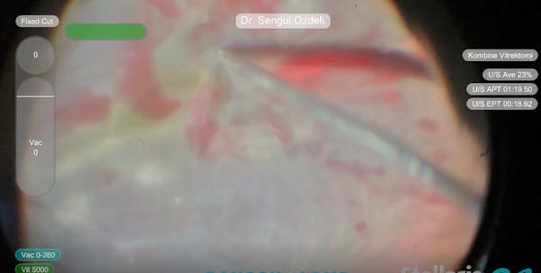 Pediatric Bilateral Leukocoria thumbnail