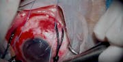 Chandelier-Assisted Scleral Buckling