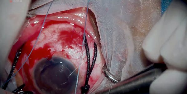 Chandelier-Assisted Scleral Buckling thumbnail