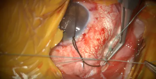 Scleral Buckling Surgery