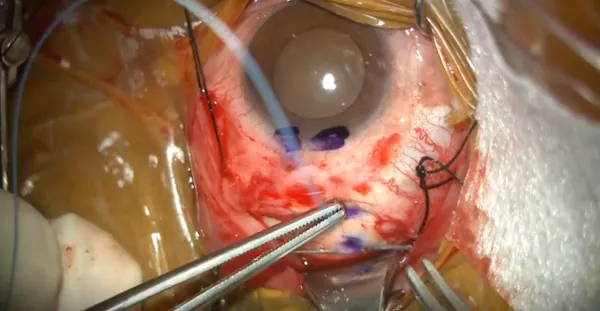 Scleral Buckling Procedure in Retina Detachment thumbnail