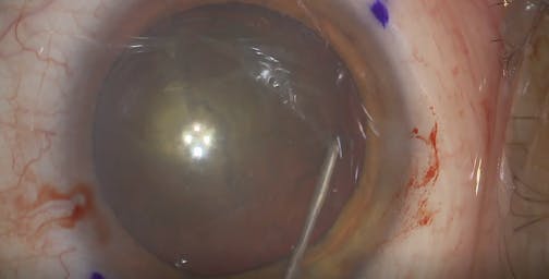 Posterior Polar Cataract Management With a Toric Lens