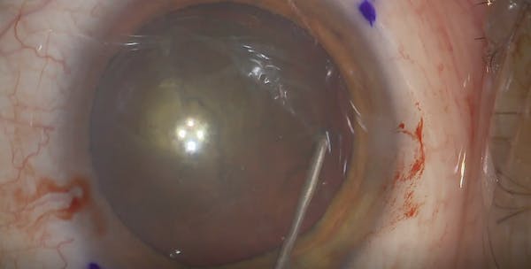 Posterior Polar Cataract Management With a Toric Lens thumbnail