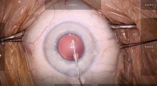 Cataract Surgery Technology: Cohesive Viscoelastic