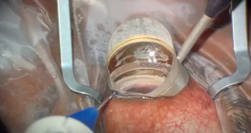 iTrack Advance: Canaloplasty Surgical Technique