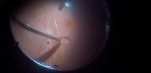 Minimally Invasive Vitrectomy for Phakic Retinal Detachment