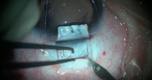360-Degree Trabeculotomy With Deep Sclerectomy for Pediatric Glaucoma