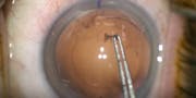 Capsular Puncture