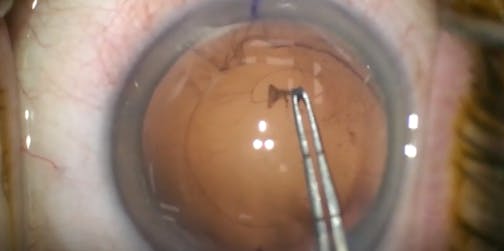 Capsular Puncture
