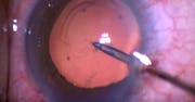 Capsular Snag