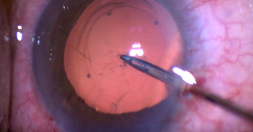 Capsular Snag
