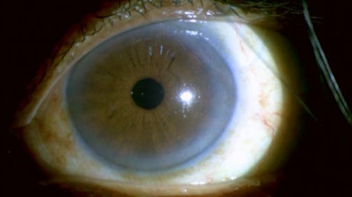 Vaccine Inflammation