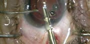 Refractive Surprise