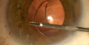 IOL Dislocation
