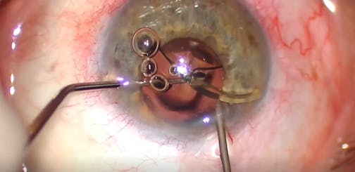 Flanged Repositioning