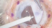 White Cornea