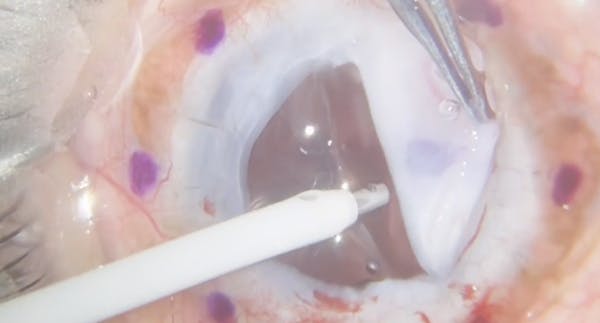 White Cornea thumbnail