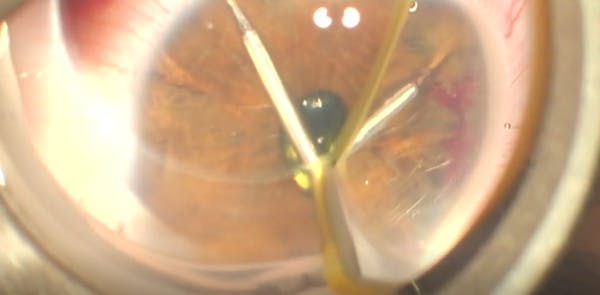 Extreme Hyperopia thumbnail