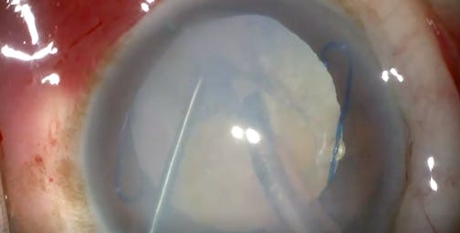 Cloudy Cornea