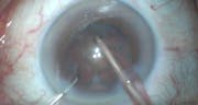 Pseudoexfoliation Syndrome