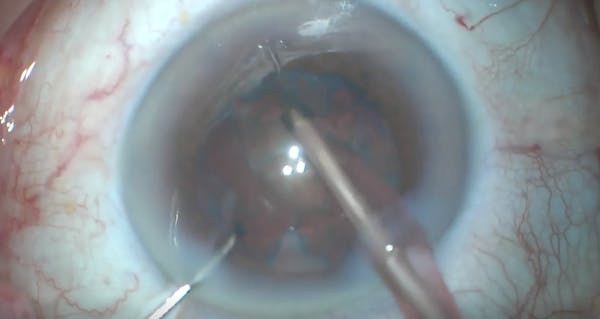 Pseudoexfoliation Syndrome thumbnail