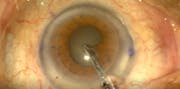 Penetrating Keratoplasty With Small Pupil