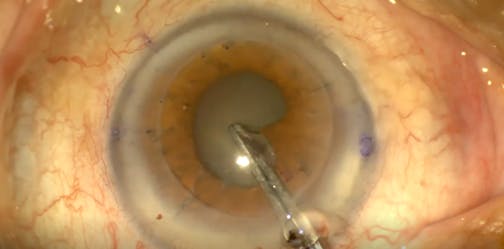 Penetrating Keratoplasty With Small Pupil