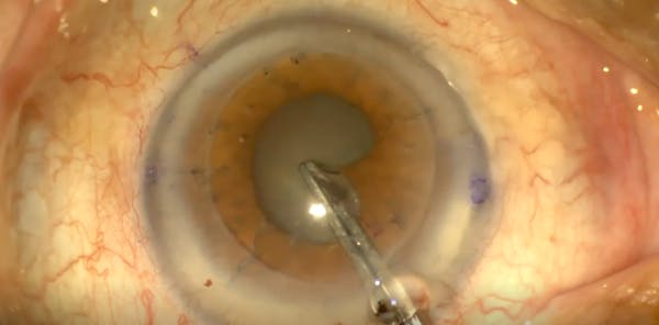 Penetrating Keratoplasty With Small Pupil thumbnail