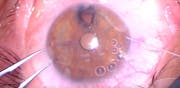 IOFB With Iris Reconstruction