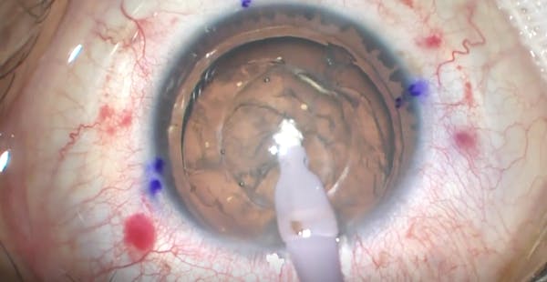 ICL With Traumatic Aniridia thumbnail
