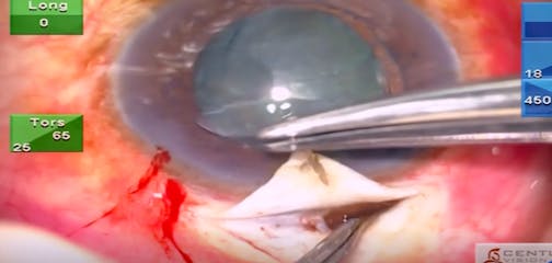 Iris Prolapse