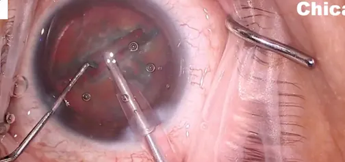 How to Perform Divide and Conquer Cataract Surgery