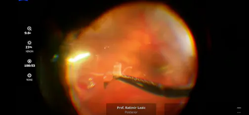 Surgical Removal of Epiciliary Membrane