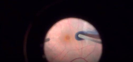 Retinal Detachment-Induced Macular Hole