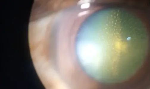 Posterior Capsule Opacification
