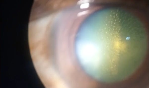 Posterior Capsule Opacification thumbnail