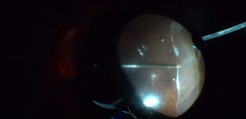 Nasal Giant Retinal Tear: A Step-By-Step Approach