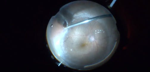 Unpredictable Retinal Detachment