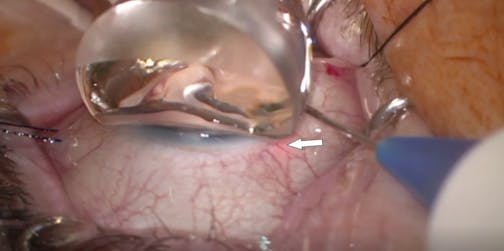 Illuminated Canaloplasty